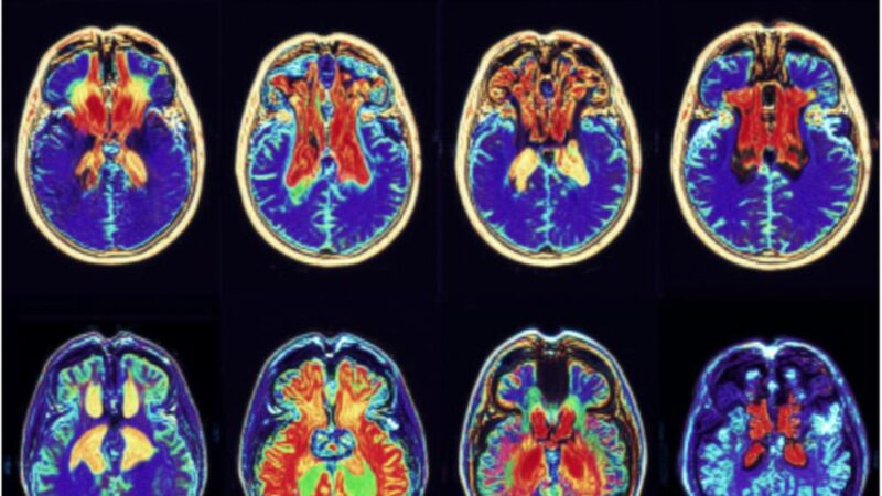 Neuropsychologia w leczeniu ADHD – jak przeprogramować mózg na sukces